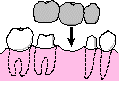 取り外し式の部分義歯