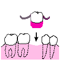 取り外し式の部分義歯1